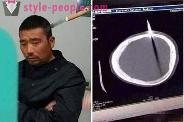 Ein chinesischer Mann mit einem Messer in den Kopf ging er zum Arzt