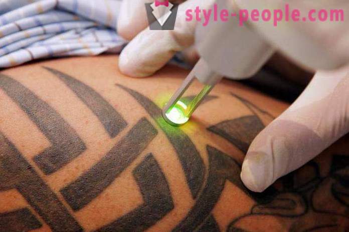 Laser Tattooentfernung. Bewertet die