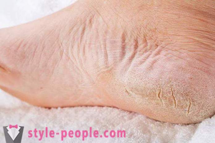 Trockene Haut an den Füßen: Ursachen