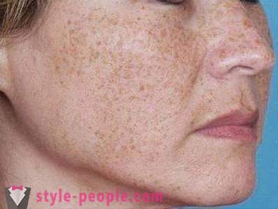 Braune Flecken auf dem Gesicht: die Ursachen und der Kampf gegen sie