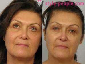 Laser-Resurfacing des Gesichts - ein sicherer Weg zu verjüngen