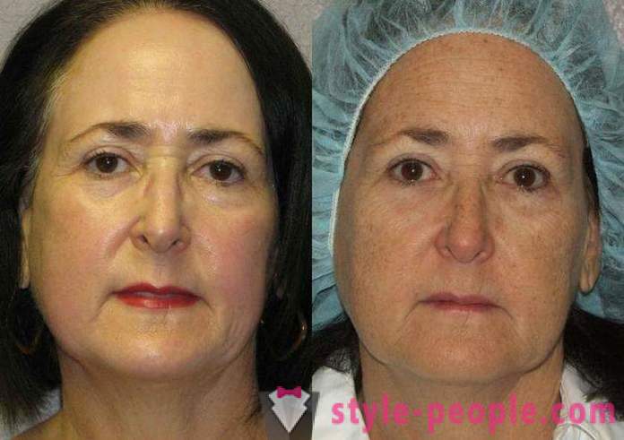Laser-Resurfacing des Gesichts - ein sicherer Weg zu verjüngen